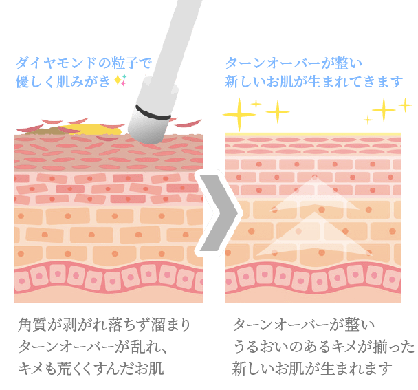 ダイヤモンドピーリングとは