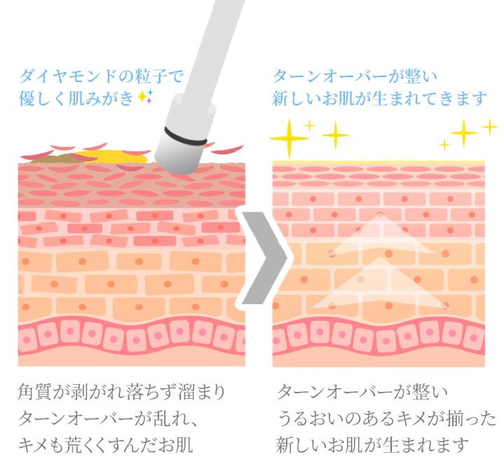 ダイヤモンドピーリング詳細