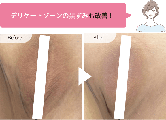 デリケートゾーン症例写真