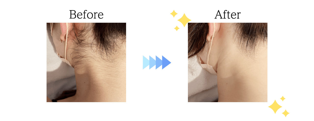 美肌脱毛Before＆After